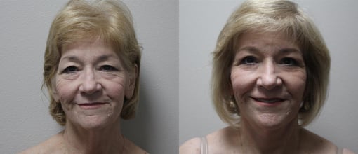 facelift necklift before and after photos by kryger institute of plastic surgery in thousand oaks ca