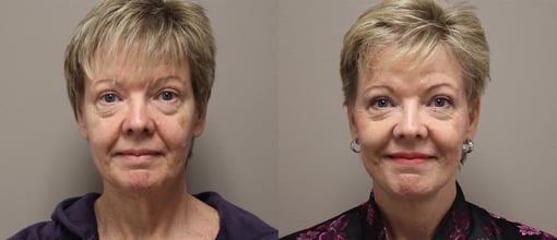 facelift necklift before and after photos by kryger institute of plastic surgery in thousand oaks ca