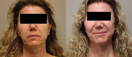 facelift necklift before and after photos by kryger institute of plastic surgery in thousand oaks ca