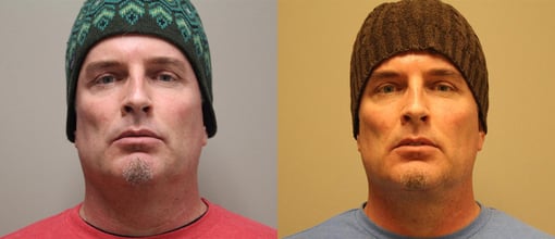 facelift necklift before and after photos by kryger institute of plastic surgery in thousand oaks ca