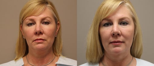 facelift necklift before and after photos by kryger institute of plastic surgery in thousand oaks ca