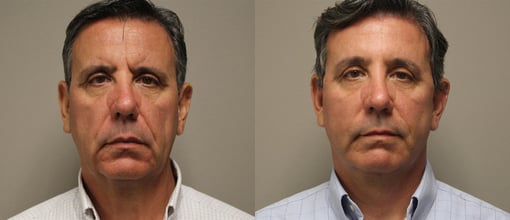 facelift necklift before and after photos by kryger institute of plastic surgery in thousand oaks ca