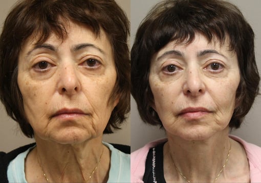 facelift necklift before and after photos by kryger institute of plastic surgery in thousand oaks ca