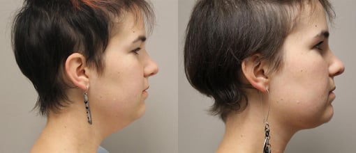facelift necklift before and after photos by kryger institute of plastic surgery in thousand oaks ca