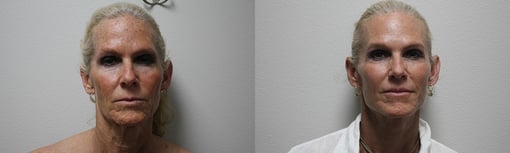 facelift necklift before and after photos by kryger institute of plastic surgery in thousand oaks ca
