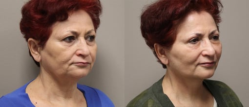 facelift necklift before and after photos by kryger institute of plastic surgery in thousand oaks ca