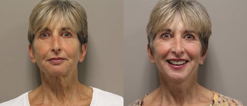 facelift necklift before and after photos by kryger institute of plastic surgery in thousand oaks ca