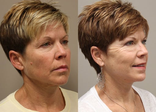 facelift necklift before and after photos by kryger institute of plastic surgery in thousand oaks ca