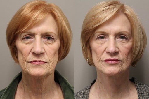 facelift necklift before and after photos by kryger institute of plastic surgery in thousand oaks ca
