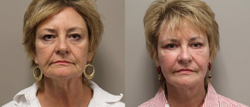 facelift necklift before and after photos by kryger institute of plastic surgery in thousand oaks ca