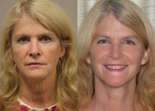 facelift necklift before and after photos by kryger institute of plastic surgery in thousand oaks ca