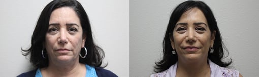 facelift necklift before and after photos by kryger institute of plastic surgery in thousand oaks ca