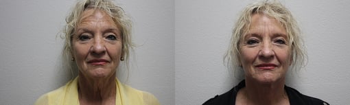 facelift necklift before and after photos by kryger institute of plastic surgery in thousand oaks ca