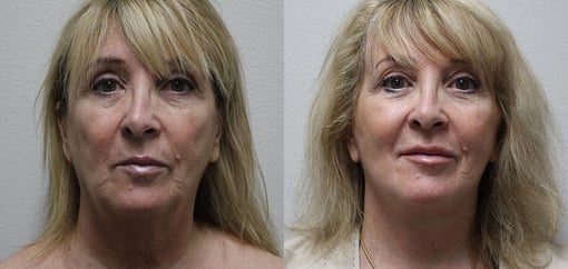 facelift necklift before and after photos by kryger institute of plastic surgery in thousand oaks ca