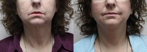 facelift necklift before and after photos by kryger institute of plastic surgery in thousand oaks ca