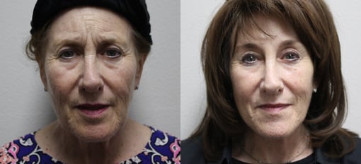 facelift necklift before and after photos by kryger institute of plastic surgery in thousand oaks ca