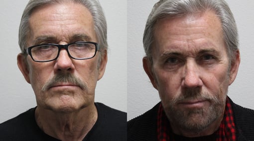 facelift necklift before and after photos by kryger institute of plastic surgery in thousand oaks ca