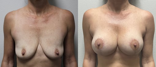 augmentation lift before and after photos by kryger institute of plastic surgery in thousand oaks ca