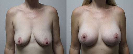 augmentation lift before and after photos by kryger institute of plastic surgery in thousand oaks ca