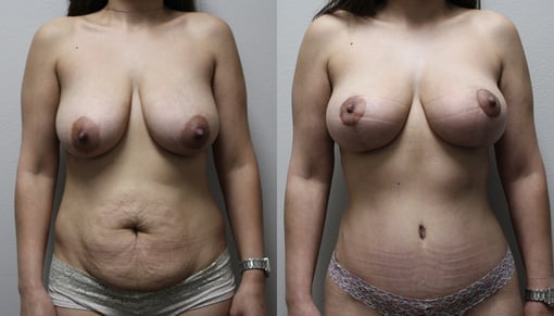 augmentation lift before and after photos by kryger institute of plastic surgery in thousand oaks ca