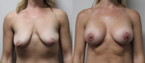 augmentation lift before and after photos by kryger institute of plastic surgery in thousand oaks ca