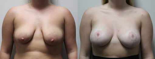 augmentation lift before and after photos by kryger institute of plastic surgery in thousand oaks ca