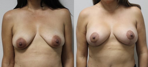 augmentation lift before and after photos by kryger institute of plastic surgery in thousand oaks ca