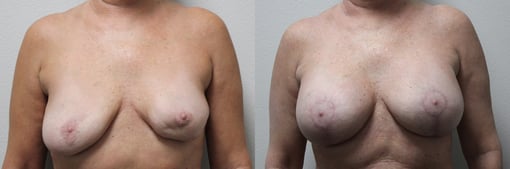 augmentation lift before and after photos by kryger institute of plastic surgery in thousand oaks ca