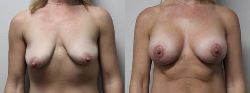 augmentation lift before and after photos by kryger institute of plastic surgery in thousand oaks ca