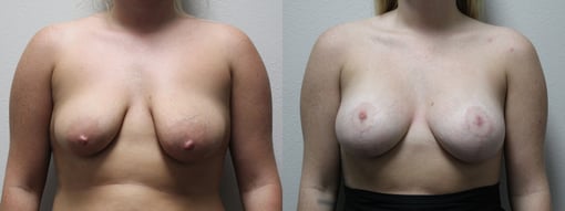 augmentation lift before and after photos by kryger institute of plastic surgery in thousand oaks ca