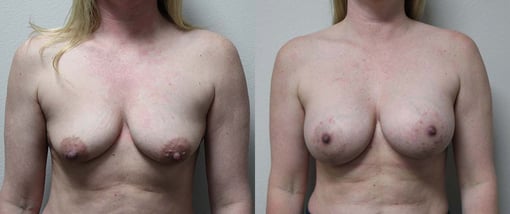 augmentation lift before and after photos by kryger institute of plastic surgery in thousand oaks ca