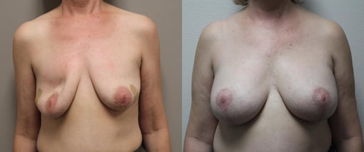 augmentation lift before and after photos by kryger institute of plastic surgery in thousand oaks ca