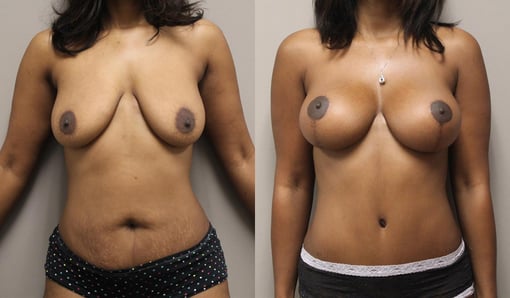 augmentation lift before and after photos by kryger institute of plastic surgery in thousand oaks ca
