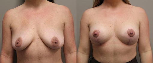 augmentation lift before and after photos by kryger institute of plastic surgery in thousand oaks ca
