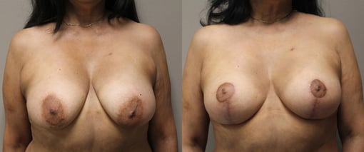 augmentation lift before and after photos by kryger institute of plastic surgery in thousand oaks ca