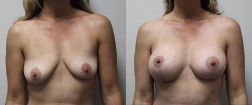 augmentation lift before and after photos by kryger institute of plastic surgery in thousand oaks ca