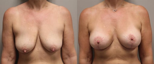 augmentation lift before and after photos by kryger institute of plastic surgery in thousand oaks ca