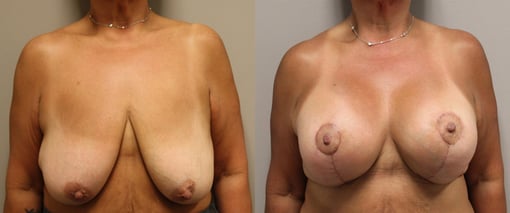 augmentation lift before and after photos by kryger institute of plastic surgery in thousand oaks ca