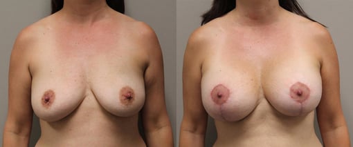 augmentation lift before and after photos by kryger institute of plastic surgery in thousand oaks ca