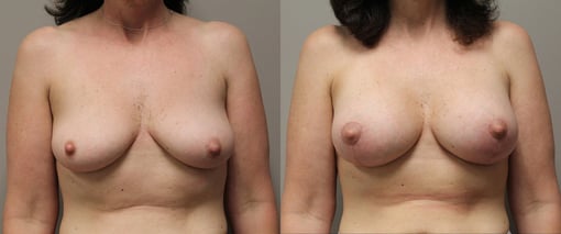 augmentation lift before and after photos by kryger institute of plastic surgery in thousand oaks ca