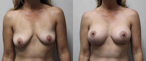 augmentation lift before and after photos by kryger institute of plastic surgery in thousand oaks ca