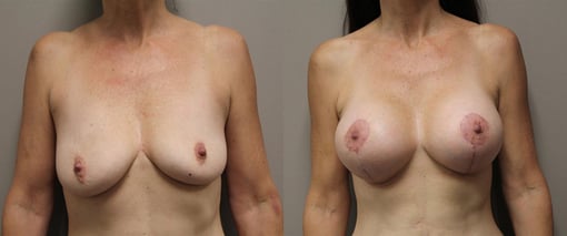 augmentation lift before and after photos by kryger institute of plastic surgery in thousand oaks ca
