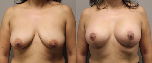 augmentation lift before and after photos by kryger institute of plastic surgery in thousand oaks ca