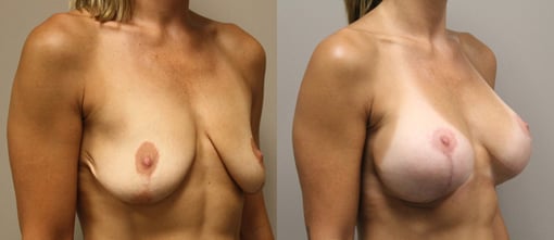 augmentation lift before and after photos by kryger institute of plastic surgery in thousand oaks ca