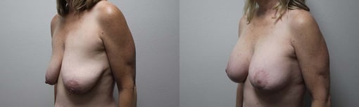 augmentation lift before and after photos by kryger institute of plastic surgery in thousand oaks ca