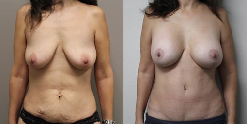 augmentation lift before and after photos by kryger institute of plastic surgery in thousand oaks ca