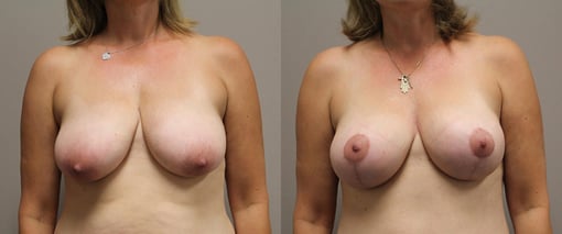 augmentation lift before and after photos by kryger institute of plastic surgery in thousand oaks ca