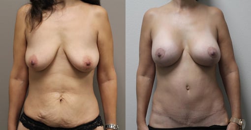 augmentation lift before and after photos by kryger institute of plastic surgery in thousand oaks ca