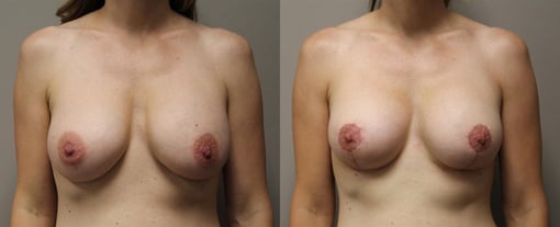 augmentation lift before and after photos by kryger institute of plastic surgery in thousand oaks ca
