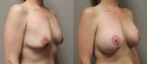 augmentation lift before and after photos by kryger institute of plastic surgery in thousand oaks ca